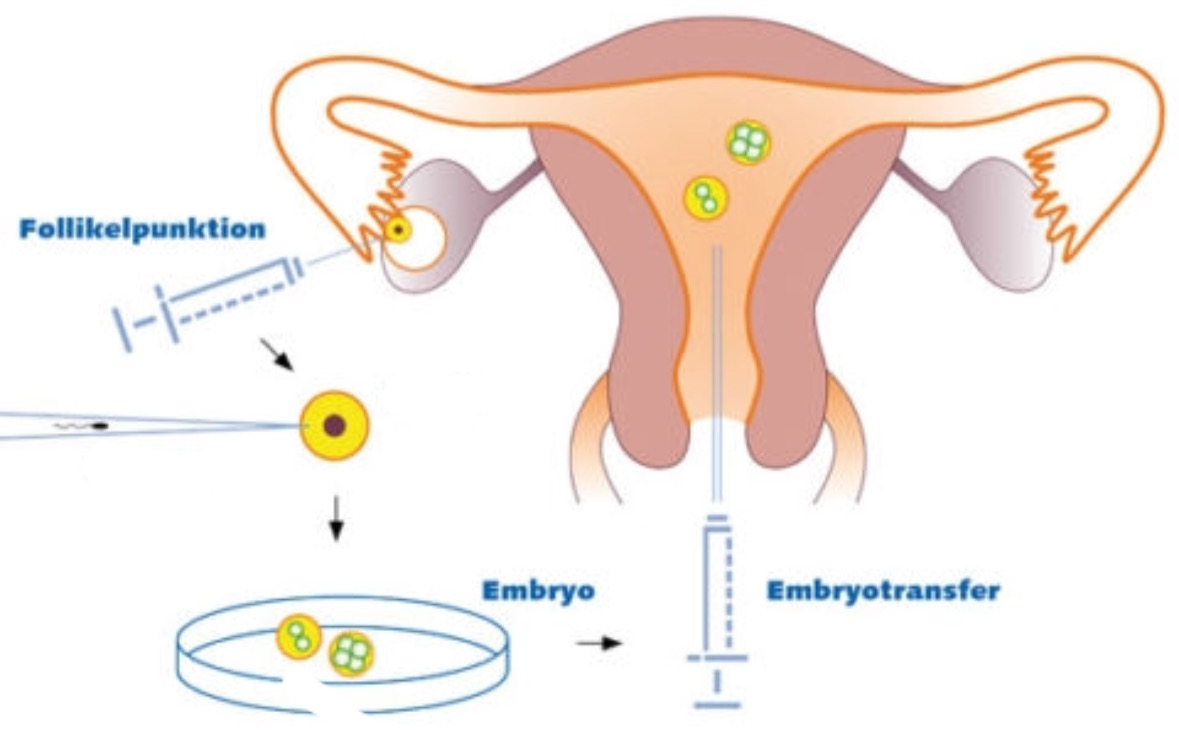 Intracytoplasmic Sperm Injection